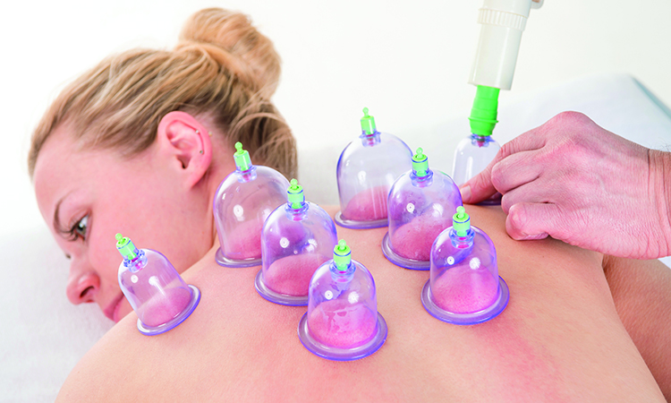 Cupping